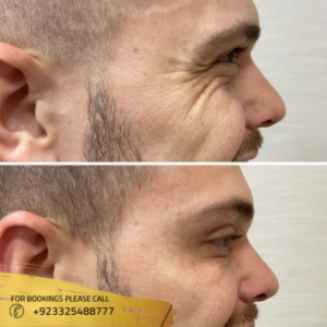 before and after of Botox injection -- Dr huma