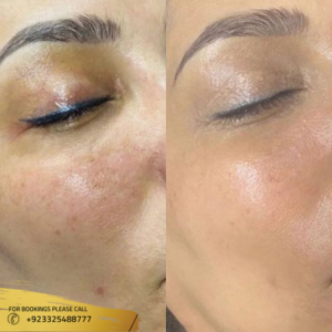 before and after results of microneedling