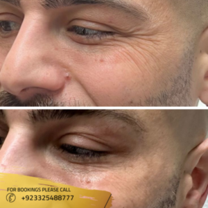 botox in islamabad by Dr Maryam Malik