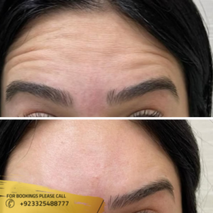 botox injections results by dr Ayusha Khan
