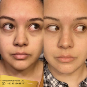 dark circles treatment near me