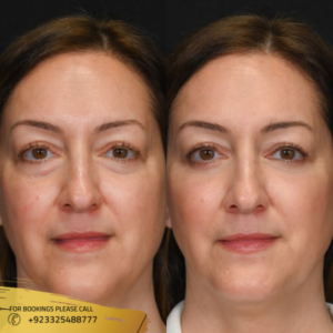 eye bags removal before and after