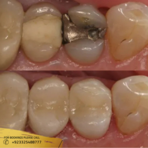 before after results of dental filling