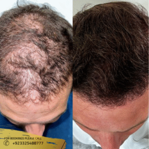 hair restoration before and after results
