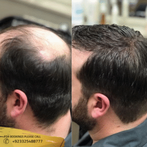 hair restoration cost in islamabad - results