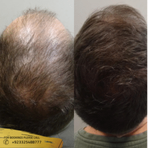hair restoration in islamabad , pakistan