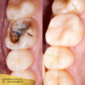 teeth filling in islamabad pakistan